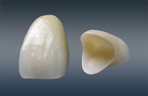 被せ物（クラウン）の種類 | 明石市の歯医者 明石アップル歯科