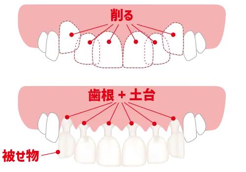 セラミック矯正