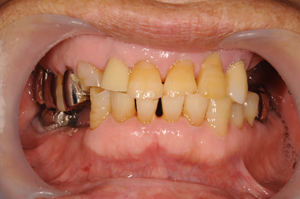 すれ違い咬合の治療 明石アップル歯科