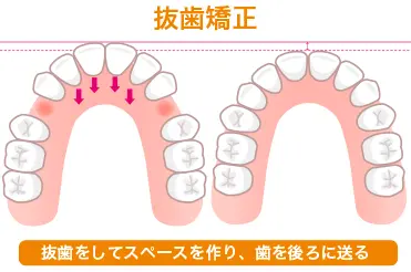 抜歯矯正のイラスト