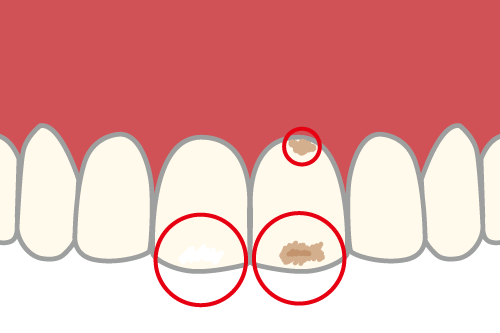 前歯の表面にできた茶色い点