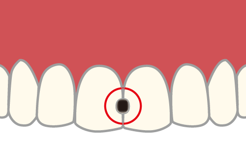 前歯の隣接面に虫歯の穴が開いたイラスト