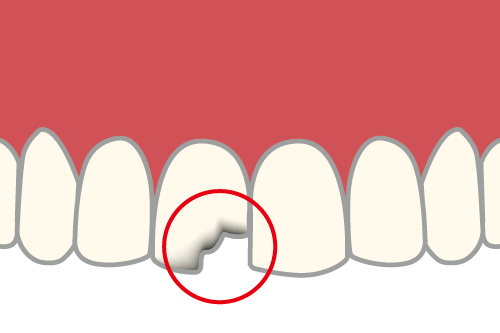 破損した歯冠のイラスト
