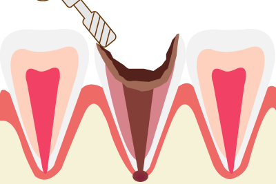 虫歯の除去