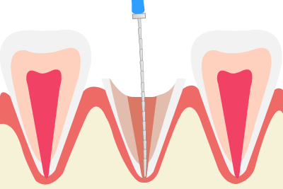 根管の洗浄