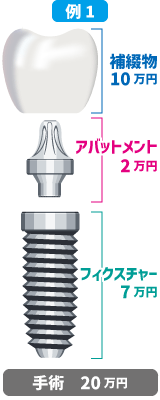 補綴物10万円+フィクスチャー7万円+アバットメント2万円+手術費20万円=40万円