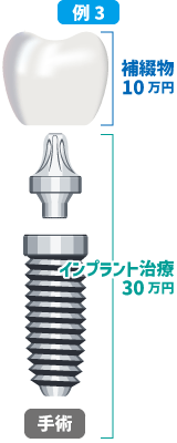 インプラント手術費30万円+補綴物10万円=40万円