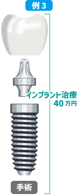 インプラント・補綴物・手術全て込40万円