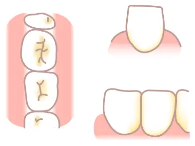 虫歯になりやすい場所の図解