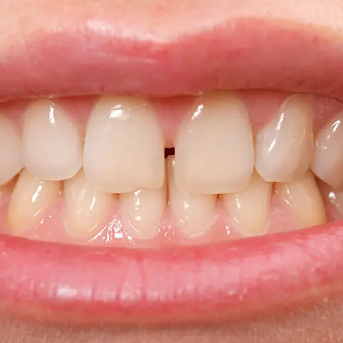 すきっ歯の拡大写真