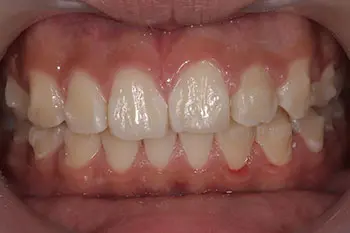 すきっ歯のインビザラインGo治療後写真
