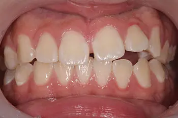 すきっ歯のインビザラインGo治療前写真