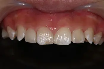 すきっ歯のダイレクトボンディング治療後写真
