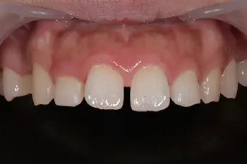 すきっ歯のダイレクトボンディング治療前写真