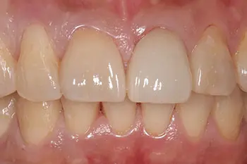 すきっ歯のラミネートベニア治療後写真