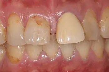 すきっ歯のラミネートベニア治療前写真