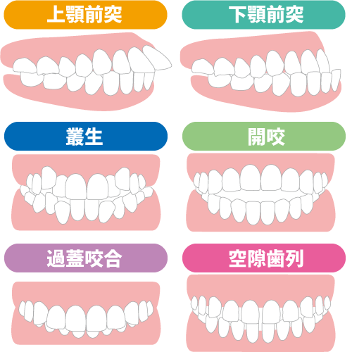 様々な不正咬合の図解