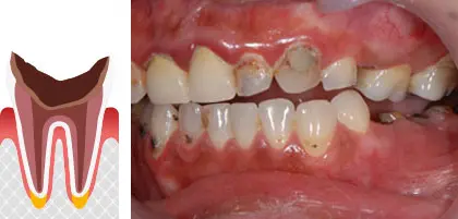 虫歯の図解と写真