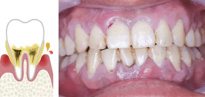 歯周病の図解と写真